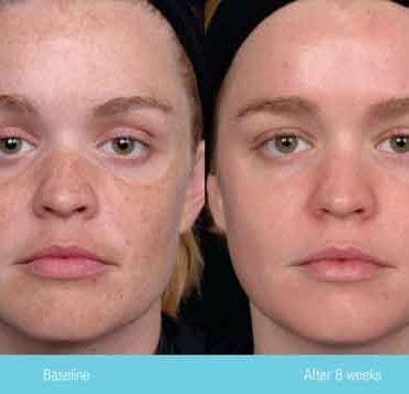 Glowing, Clear and Blemish-Free Skin for the 30+ Bride – Part 1